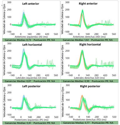 Case Report: Isolated Idiopathic Saccular Dysfunction